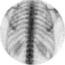 Gammagrafía ósea de la columna dorsal