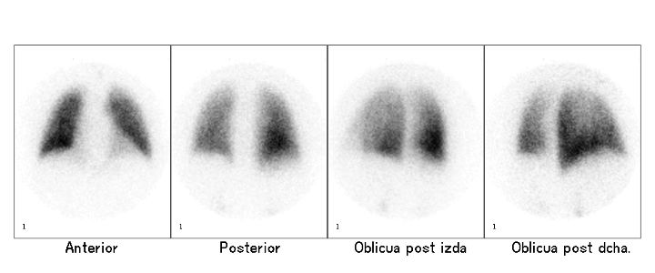 Gammagrafía pulmonar de ventilación