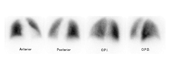 Gammagrafía pulmonar de perfusión
