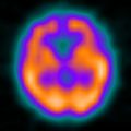 SPECT cerebral